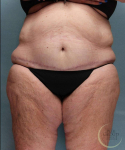 After Weight Loss Surgery Case 122 After